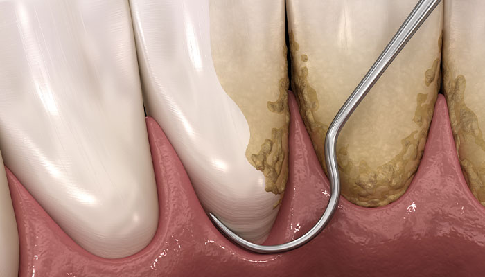 歯と歯肉の間に溜まっていた歯石や歯垢（プラーク）除去